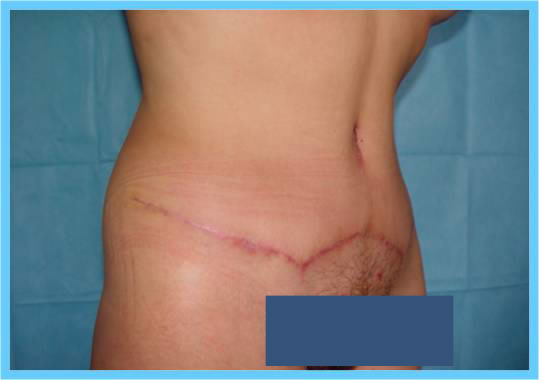 abdominoplasty